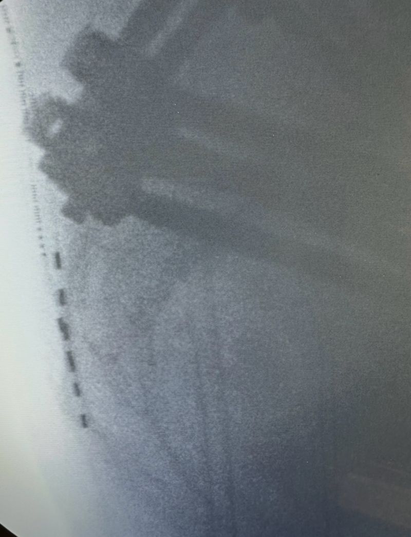 Real or made up? Is the middle cluneal nerve and