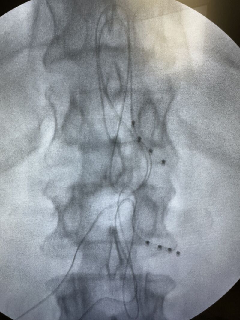 📢 Dorsal Root Ganglion (DRG) stimulation continues to expand beyond
