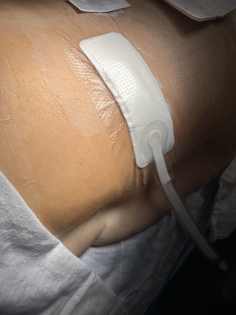 Wound Optimization in High Risk Patients: Does anyone else utilize